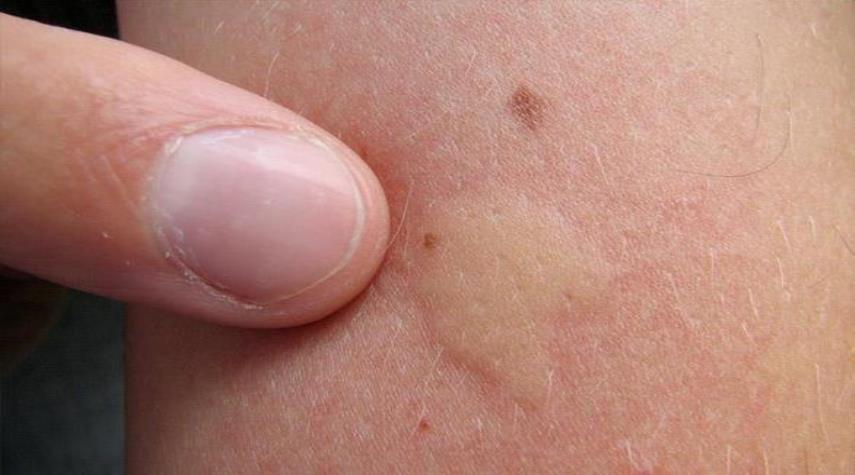 أعراض "غير عادية" لسرطان الجلد... ما هي؟